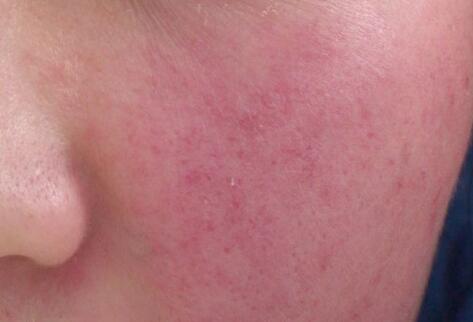 如何拯救你的敏感??？廣西南寧美容培訓(xùn)叫你正確方法