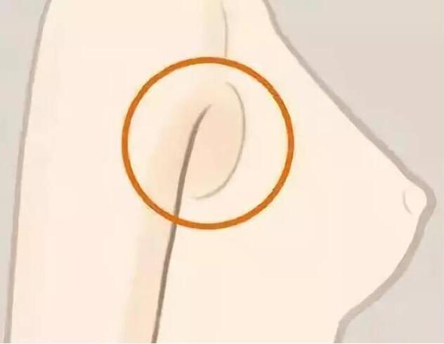 減副乳，瘦手臂一招就解決！