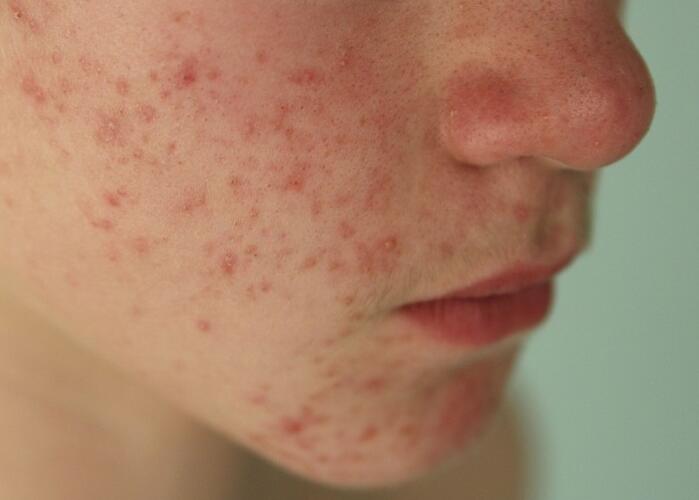 粉刺閉口應(yīng)該如何處理？