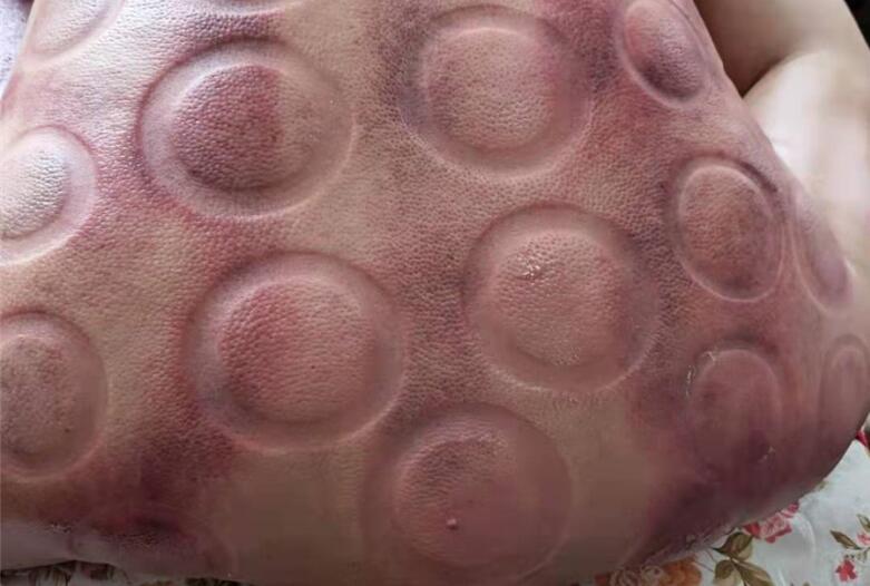 怎樣拔火罐？南寧美容學(xué)校手把手教你