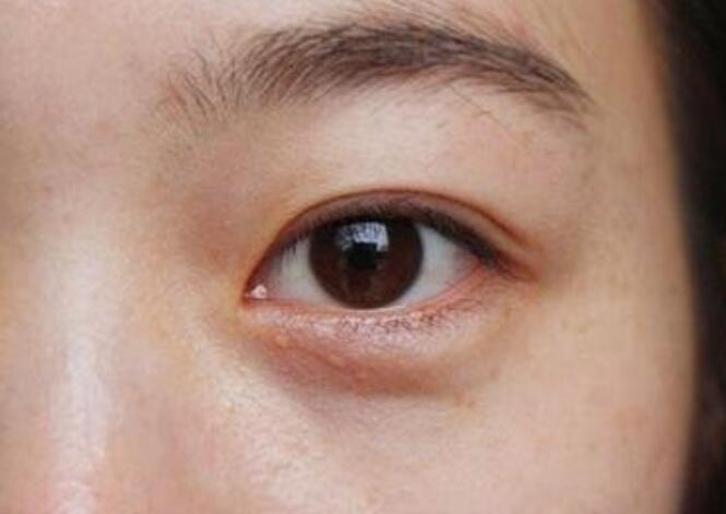 黑眼圈的種類有哪些？廣西美容培訓教你保養(yǎng)