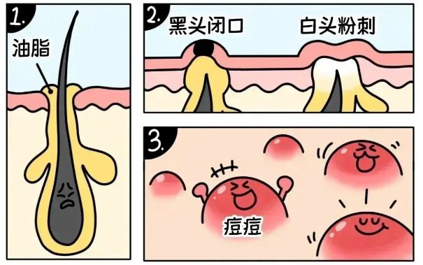 不同部位閉口形成的原因，南寧美容護膚學校解答