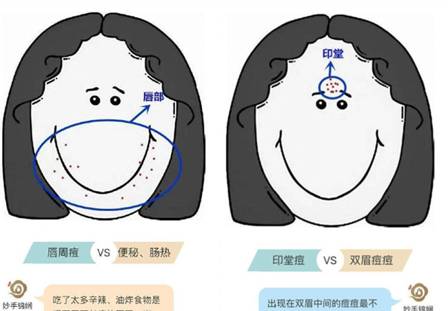 南寧皮膚管理學(xué)校排名：臉上不同部位長(zhǎng)痘的原因及改善方法