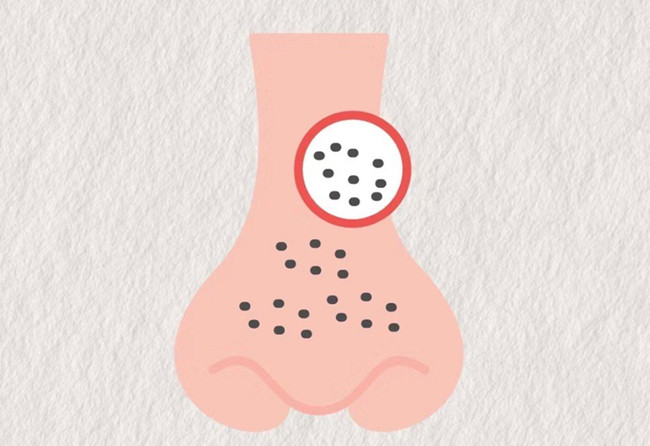 廣西皮膚管理師：面對嚴重的黑頭應該怎么辦？