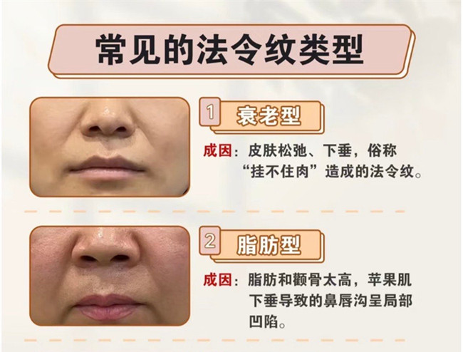 你的法令紋路是怎么產(chǎn)生的 | 美容護(hù)膚小知識(shí)